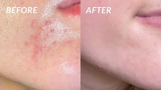 How I COMPLETELY got rid of my PERIORAL DERMATITIS in 4 DAYS the secret cure [upl. by Ojeibbob946]