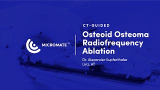 Micromate™  CTguided RoboticAssisted Osteoid Osteoma Radiofrequency Ablation [upl. by Servais921]