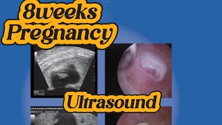 8 weeks Pregnancy  Early Pregnancy  Alive Fetus  Anomaly Scan  Normal Obs Ultrasound [upl. by Hyrup981]