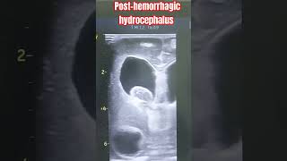 Neonatal Cranial Ultrasound  showing Posthemorrhagic hydrocephalus in preterm neonates pocus [upl. by Gerta164]