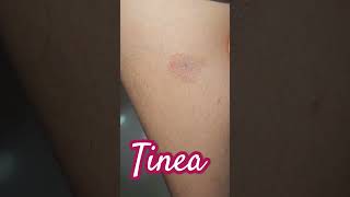 Tinea Infection imwell tinea [upl. by Derwood]