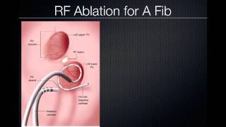 Pulmonary Vein Ablation Cardiac CT [upl. by Pembroke]