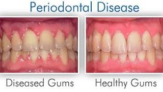 quotSaveYourSmile Understanding Periodontitis and Howto Prevent Itquotgumdisease oralhealthdentist [upl. by Annorah]