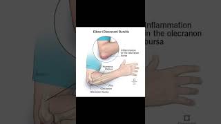 Elbow bursitisexcercisethephysiodoctoranatomyphysiotharapisthumananatomysportselbowpain [upl. by Nilats650]