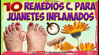 COMO ELIMINAR LOS JUANETES con Estos 10 Remedios Caseros Para los JUANETES INFLAMADOS [upl. by Nelsen]