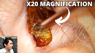 X20 Magnification Ear Wax Removal [upl. by Yasmar]