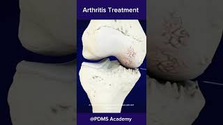 How to treat Arthritis best treatment for rheumatoid arthritis medicine [upl. by Nazario]