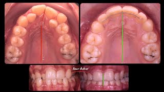 Step by step orthodontic space opening for completely blocked lateral incisor by Dr Amr Asker [upl. by Haikezeh]