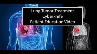 Lung Cancer Treatment  Cyberknife  Pasadena Cyberknife [upl. by Campbell]