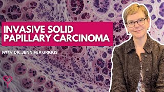 What is Invasive Solid Papillary Carcinoma and How is it Treated [upl. by Lledor]