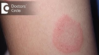 How to manage Chronic Ringworm infection  Dr Rajdeep Mysore [upl. by Rhine852]