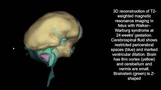 Prenatal diagnosis of Walker–Warburg syndrome [upl. by Ansilma]