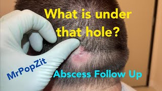 What is under that enlarged pore Large abscess follow up cyst has reformed and I cut it out [upl. by Ayak]