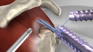 Knotless Rotator Cuff Repair with Arthrex® SpeedFix™ [upl. by Oleusnoc99]