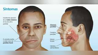 SIALOADENITIS INFECCIÓN DE LAS GLANDULAS SALIVALES BULTO EN REGION MAXILAR [upl. by Lewej]