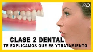 👉Maloclusion dental  𝙈𝙤𝙧𝙙𝙞𝙙𝙖 𝘾𝙡𝙖𝙨𝙚 𝙄𝙄 dental en Ortodoncia  que es y como corregirla [upl. by Odnumyar]