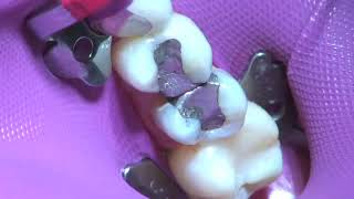 Palodent® Plus  Isolation of a Class II Restoration  Dentsply Sirona [upl. by Avivah876]