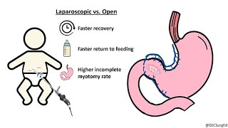 Hypertrophic Pyloric Stenosis [upl. by Eldwun]