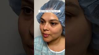 Before amp After Trifecta Lift  Latina Patient  Dr Kami Parsa Beverly Hills [upl. by Aleil]