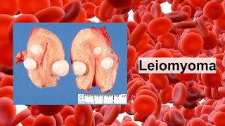 leiomyoma [upl. by Dugas]