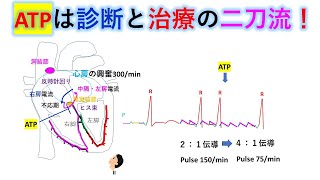 心電図：暗記からの卒業 131話 ATPによる頻拍の鑑別 [upl. by Leahicm]