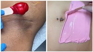 👉Armpitabdomen hair removal waxing queen adventures [upl. by Natsreik]