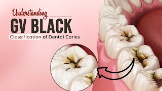 Understanding GV Black Classification of Dental Caries  Dentalkart [upl. by Sidoma654]